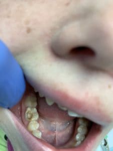TREATMENT AND TOOTH FILLING